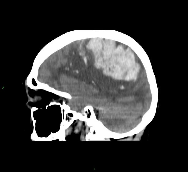 File:Cerebral amyloid angiopathy-associated lobar intracerebral hemorrhage (Radiopaedia 58751-65972 C 22).jpg