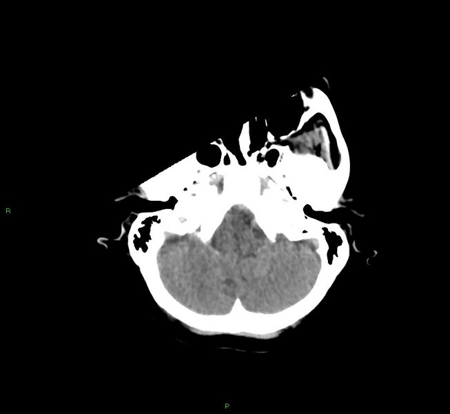 File:Cerebral amyloid angiopathy-associated lobar intracerebral hemorrhage (Radiopaedia 58754-65975 Axial non-contrast 49).jpg