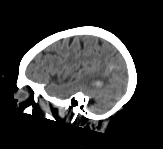 File:Cerebral amyloid angiopathy-associated lobar intracerebral hemorrhage (Radiopaedia 58757-65978 C 41).jpg
