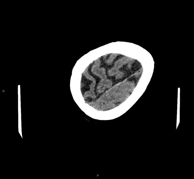 File:Cerebral amyloid angiopathy-associated lobar intracerebral hemorrhage (Radiopaedia 58757-65979 Axial non-contrast 128).jpg