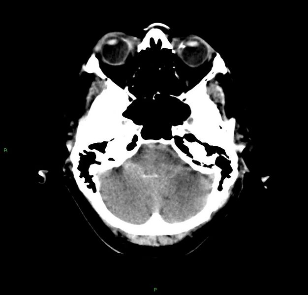 File:Cerebral amyloid angiopathy-associated lobar intracerebral hemorrhage (Radiopaedia 59356-66716 Axial non-contrast 38).jpg