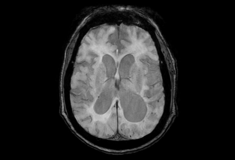 File:Cerebral amyloid angiopathy (Radiopaedia 86671-102792 Axial Gradient Echo 24).jpg