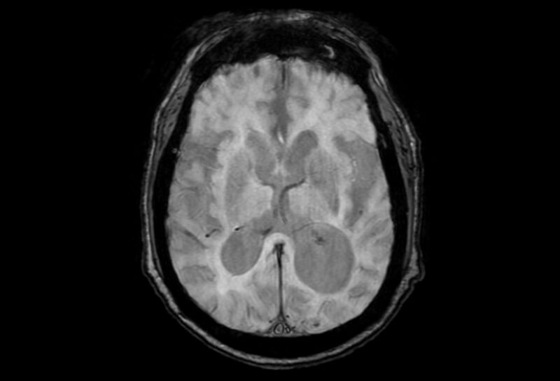 File:Cerebral amyloid angiopathy (Radiopaedia 86671-102792 Axial Gradient Echo 26).jpg