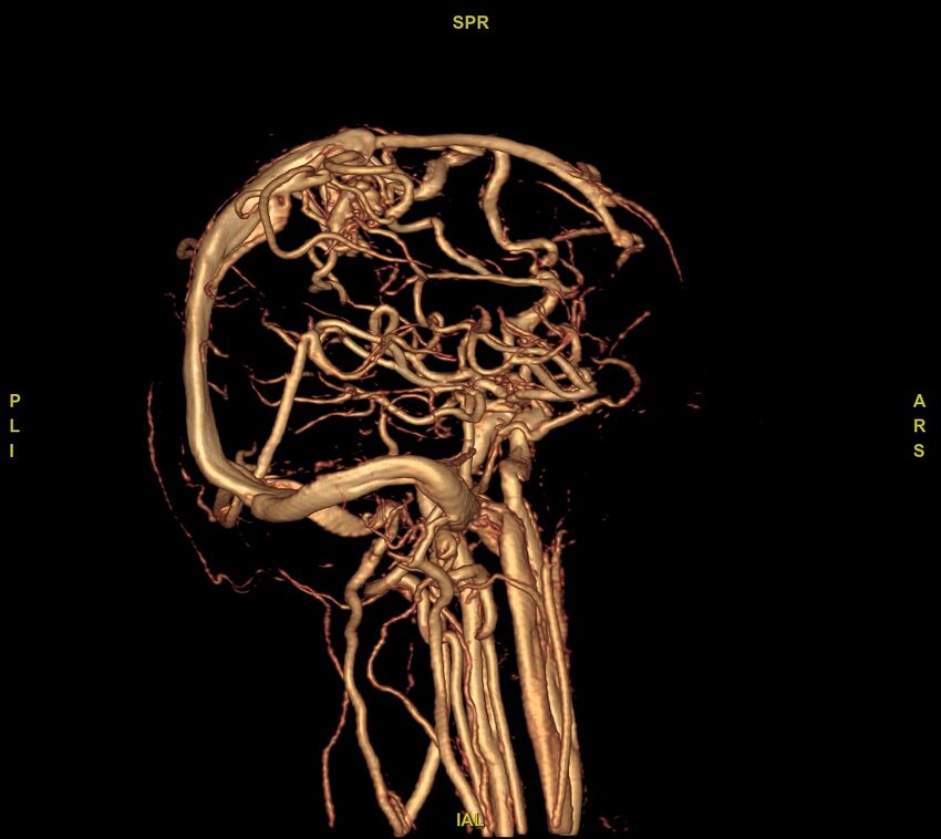 Cerebral arteriovenous malformation (Radiopaedia 61964-70029 VRT 24).jpg