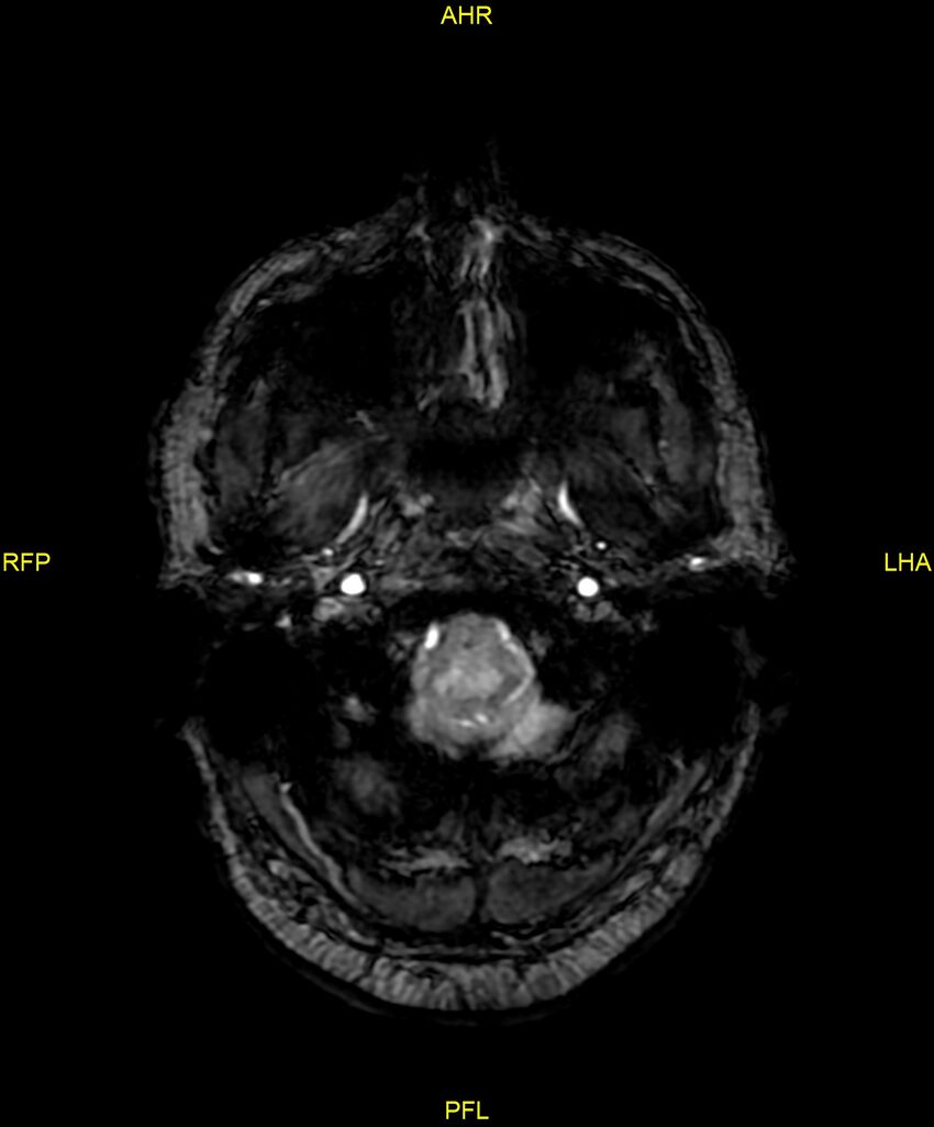 Cerebral autosomal dominant arteriopathy with subcortical infarcts and leukoencephalopathy (CADASIL) (Radiopaedia 86108-102054 Axial SWI 13).jpg