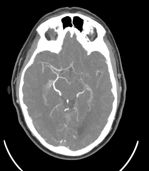 File:Cerebral dural venous sinus thrombosis (Radiopaedia 86514-102576 A 50).jpg