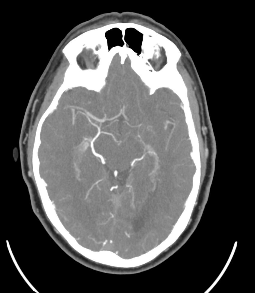Cerebral dural venous sinus thrombosis (Radiopaedia 86514-102576 A 50).jpg