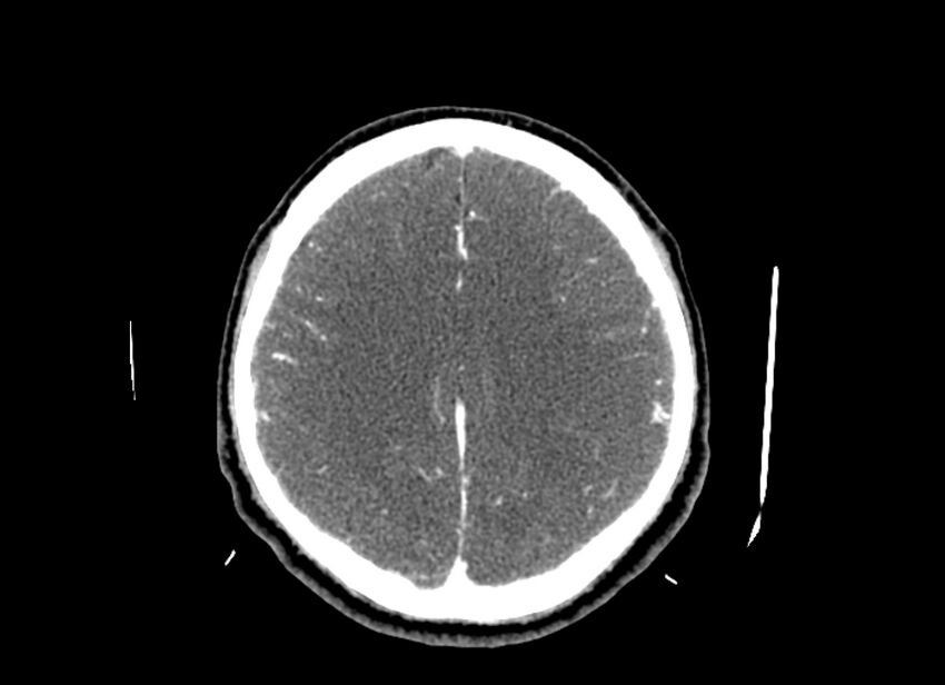 Cerebral edema (Radiopaedia 82519-96661 B 21).jpg