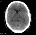 Cerebral hemorrhagic contusion with subdural and subarachnoid hemorrhage (Radiopaedia 10680-11146 Axial non-contrast 12).jpg