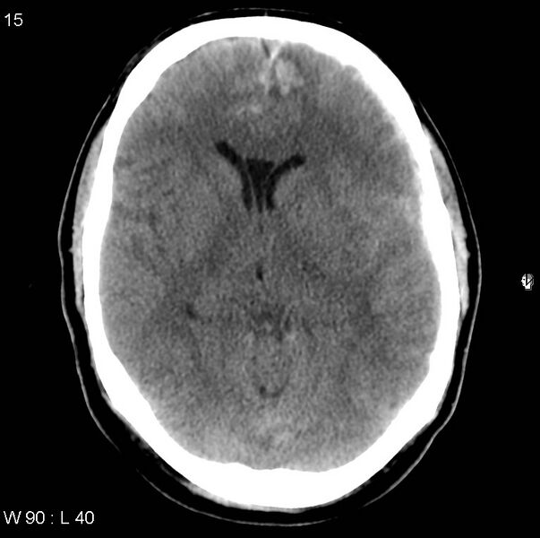 File:Cerebral hemorrhagic contusion with subdural and subarachnoid hemorrhage (Radiopaedia 10680-11146 Axial non-contrast 12).jpg