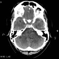 Cerebral hemorrhagic contusion with subdural and subarachnoid hemorrhage (Radiopaedia 10680-11146 Axial non-contrast 6).jpg