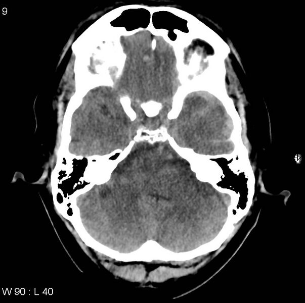 File:Cerebral hemorrhagic contusion with subdural and subarachnoid hemorrhage (Radiopaedia 10680-11146 Axial non-contrast 6).jpg