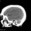 Cerebral hemorrhagic contusion with subdural and subarachnoid hemorrhage (Radiopaedia 10680-11146 C 1).jpg