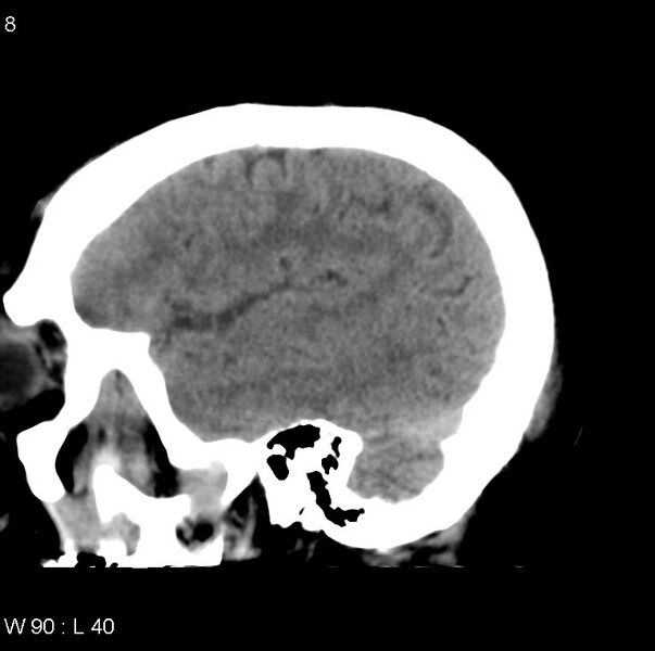 File:Cerebral hemorrhagic contusion with subdural and subarachnoid hemorrhage (Radiopaedia 10680-11146 C 1).jpg