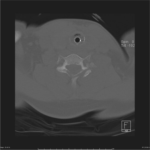 File:Cerebral hemorrhagic contusions and cervical spine fractures (Radiopaedia 32865-33841 C 25).jpg