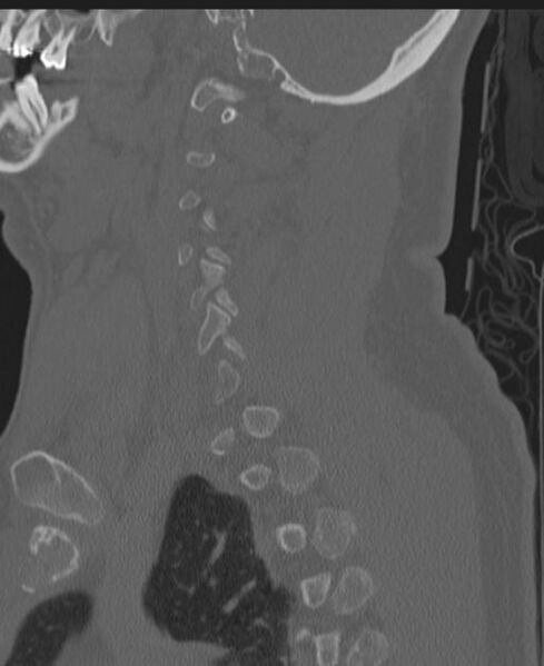 File:Cerebral hemorrhagic contusions and cervical spine fractures (Radiopaedia 32865-33841 Sagittal bone window 70).jpg