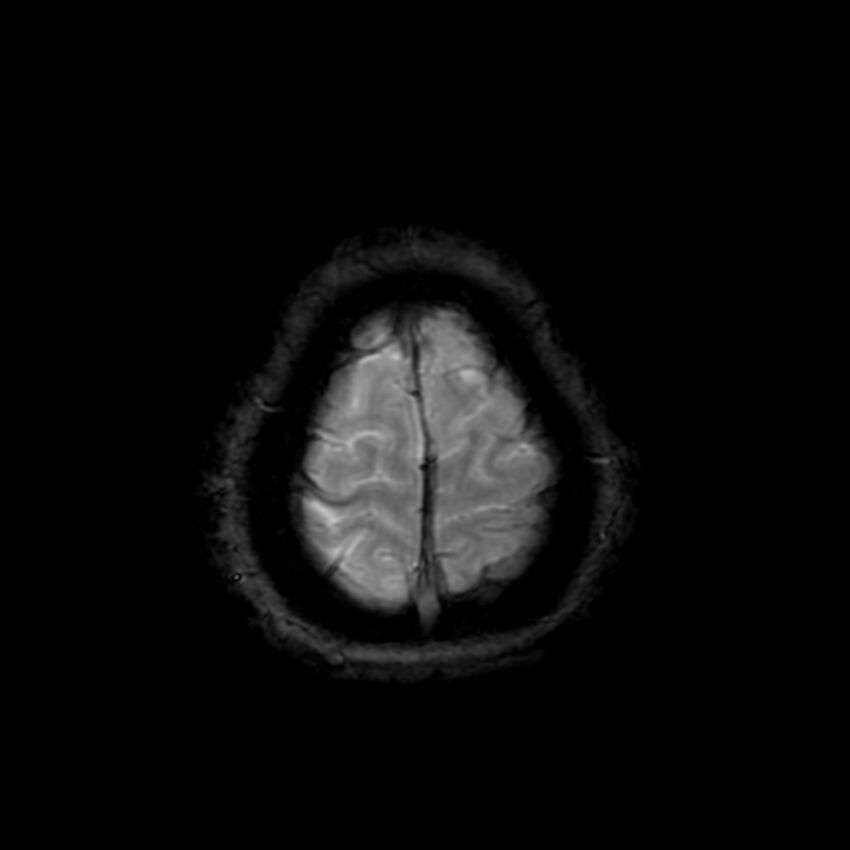 Cerebral paragonimiasis (Radiopaedia 73473-84238 Axial SWI 63).jpg
