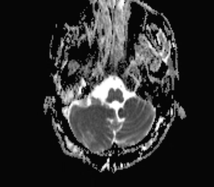 File:Cerebral venous thrombosis (Radiopaedia 71207-81504 Axial ADC 3).jpg
