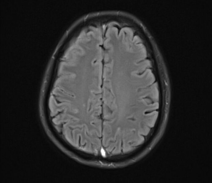 File:Cerebral venous thrombosis (Radiopaedia 71207-81504 Axial FLAIR 19).jpg