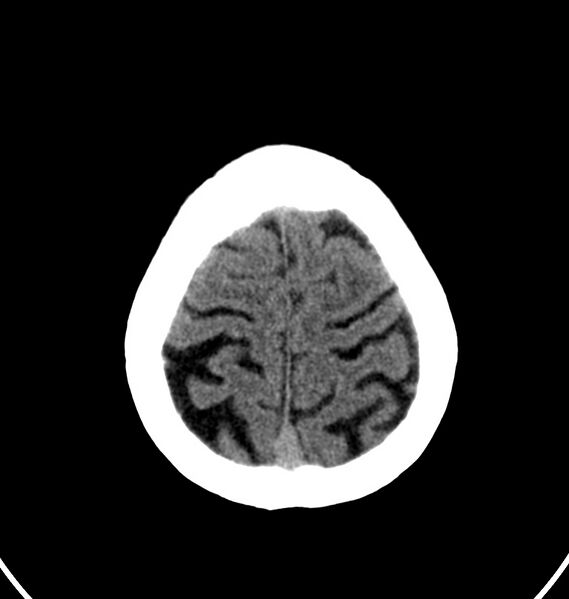 File:Cerebral venous thrombosis - CT only (Radiopaedia 41031-43778 Axial non-contrast 7).jpg