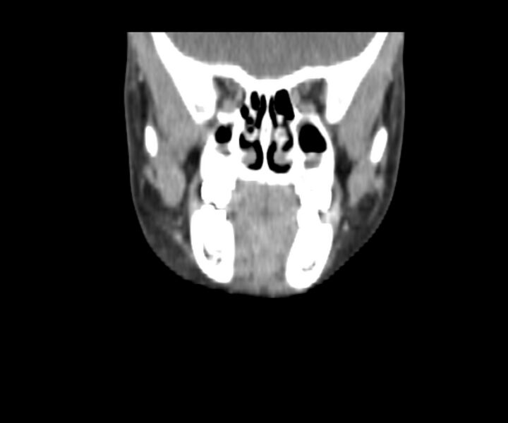 File:Cervical cystic lymphangioma (Radiopaedia 63655-72332 Coronal + contrast 12).jpg