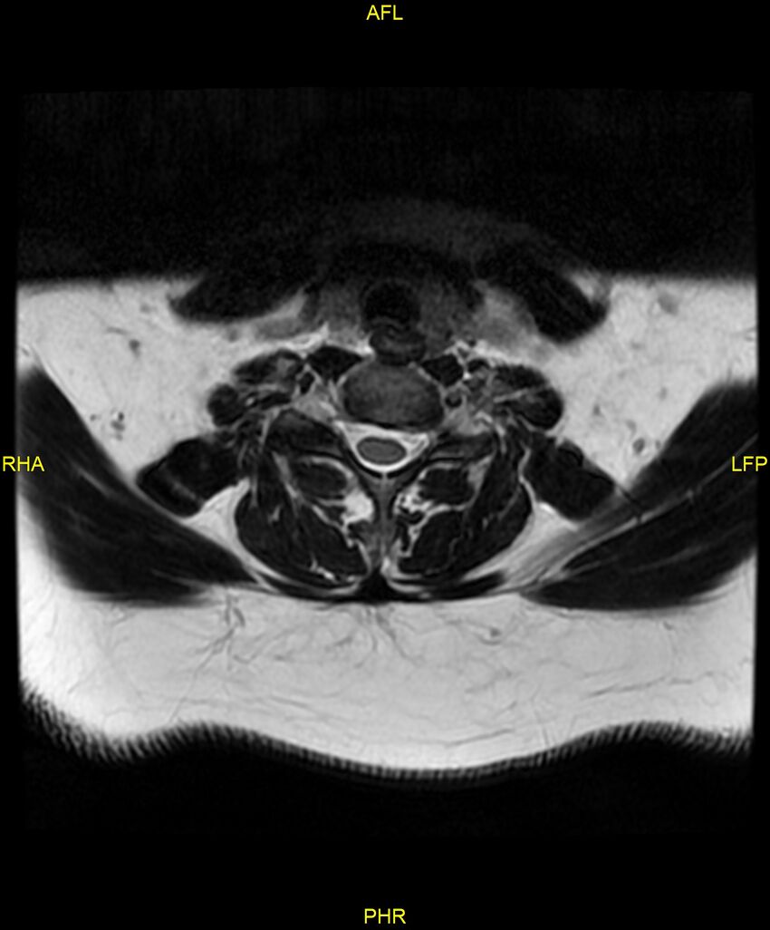 Cervical disc protrusion (Radiopaedia 87147-103415 Axial T2 48).jpg