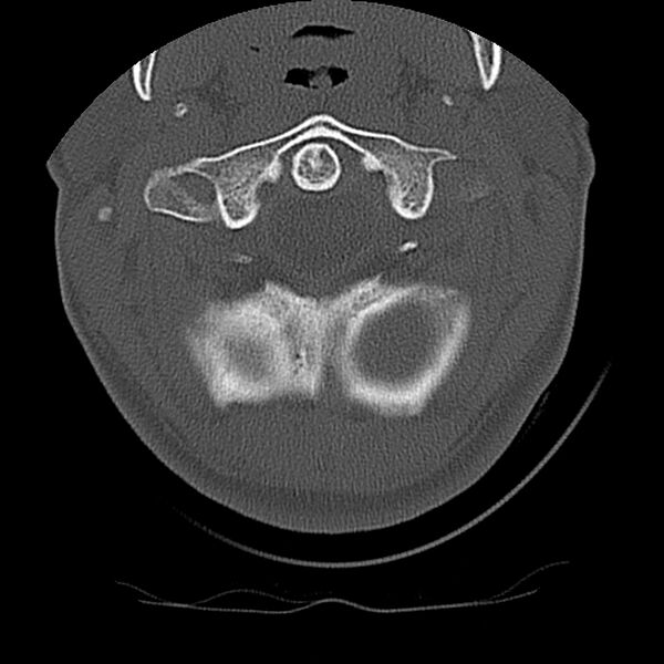 File:Cervical flexion teardrop fracture with cord hemorrhage (Radiopaedia 32497-33454 Axial bone window 15).jpg