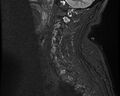 Cervical schwannoma (Radiopaedia 72399-82934 Sagittal STIR 4).jpg