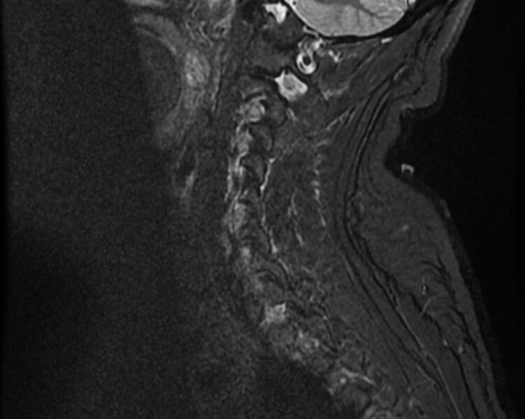 File:Cervical schwannoma (Radiopaedia 72399-82934 Sagittal STIR 4).jpg