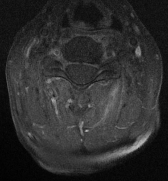 File:Cervical spondylodiscitis (Radiopaedia 81362-95110 Axial T1 C+ fat sat 8).jpg