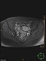 Cesarian scar endometriosis (Radiopaedia 68495-78066 Axial T1 C+ fat sat 9).jpg