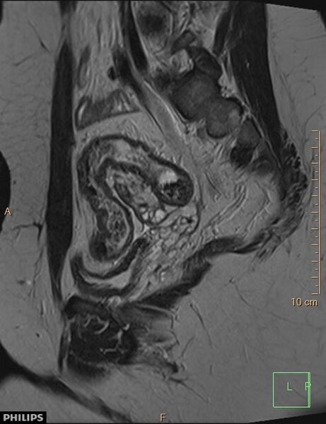 File:Cesarian scar endometriosis (Radiopaedia 68495-78066 Sagittal T2 9).jpg