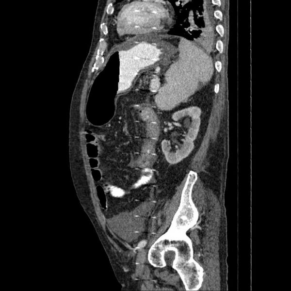 File:Cholangitis and abscess formation in a patient with cholangiocarcinoma (Radiopaedia 21194-21100 B 5).jpg