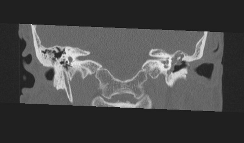 File:Cholesteatoma (Radiopaedia 10742-11203 Coronal bone window 12).jpg