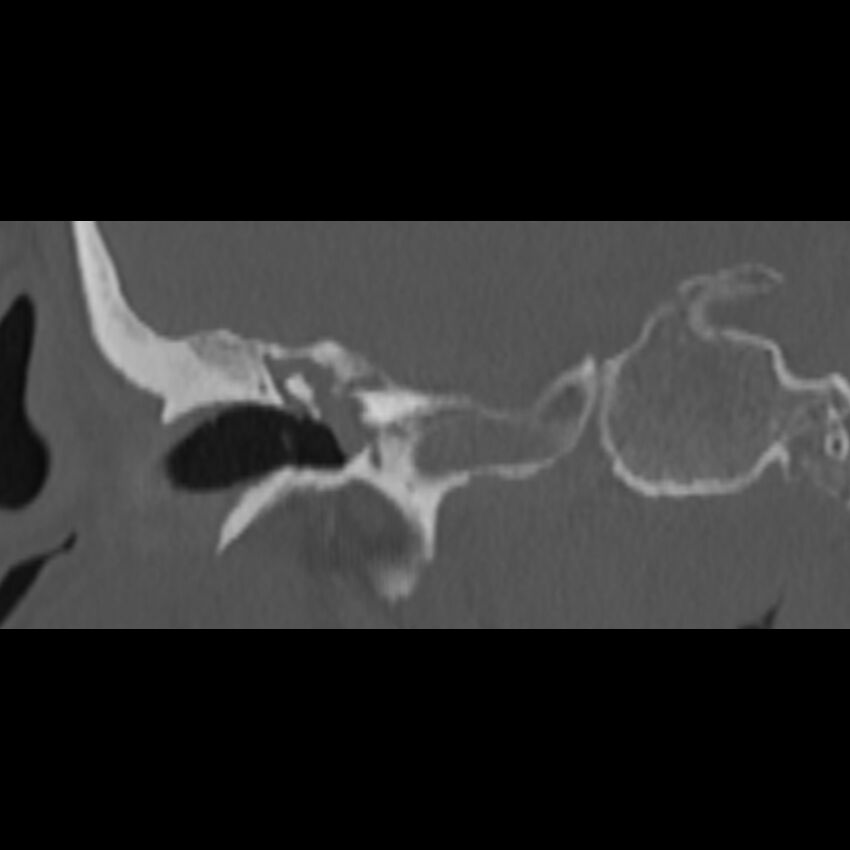 Cholesteatoma (Radiopaedia 68176-77673 Coronal bone window 28).jpg