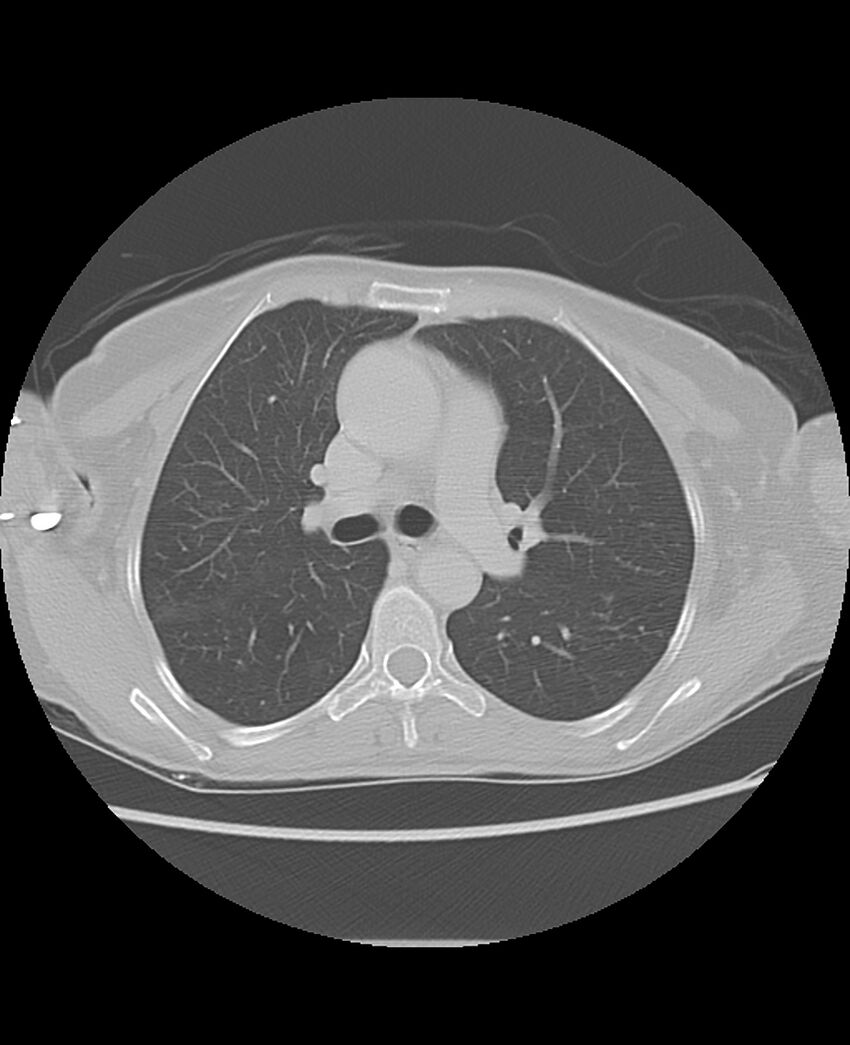 Chondrosarcoma (Radiopaedia 79427-92532 Axial lung window 23).jpg