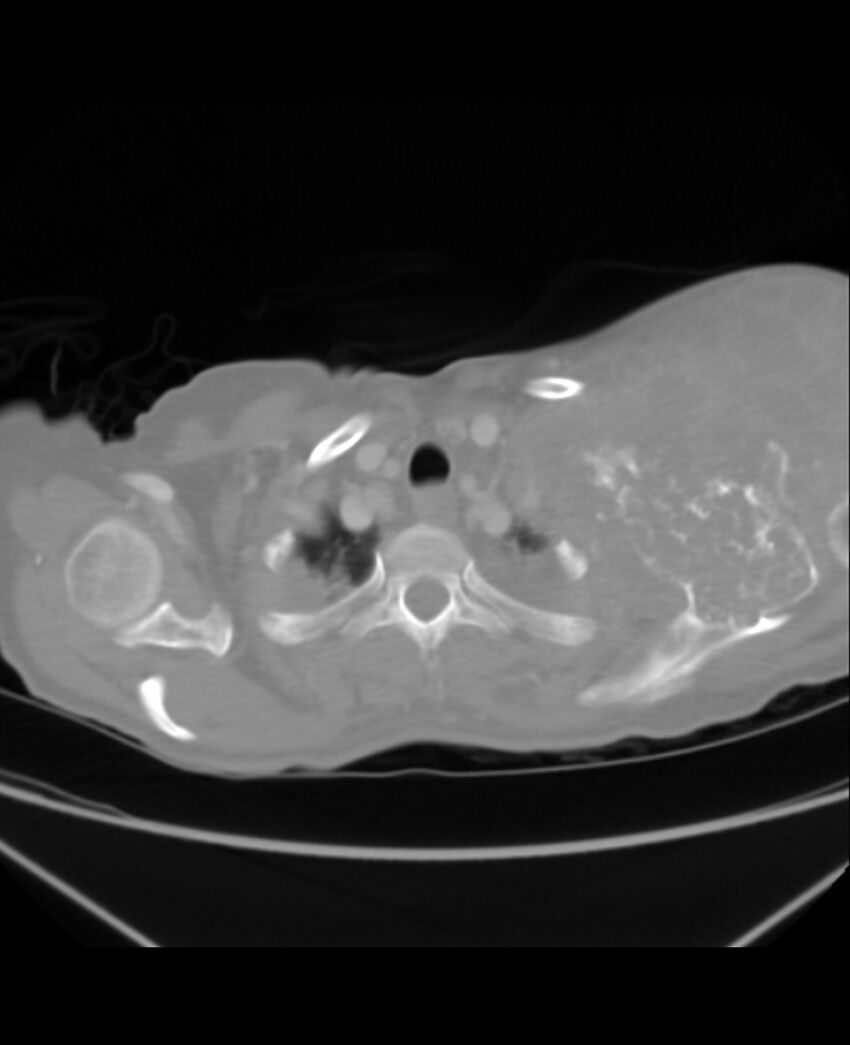 Chondrosarcoma (Radiopaedia 79427-92535 Axial lung window 5).jpg