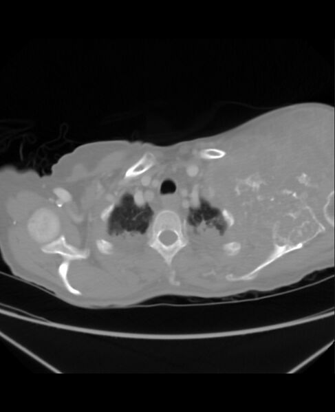 File:Chondrosarcoma (Radiopaedia 79427-92535 Axial lung window 6).jpg