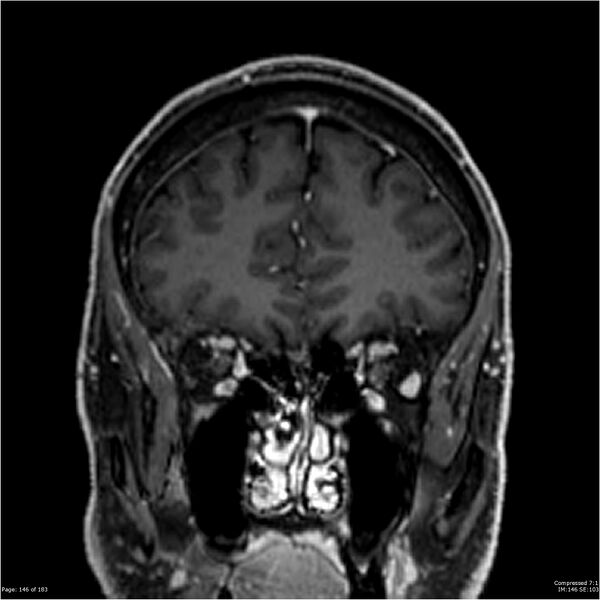 File:Chondrosarcoma of skull base- grade II (Radiopaedia 40948-43654 Coronal T1 C+ 57).jpg