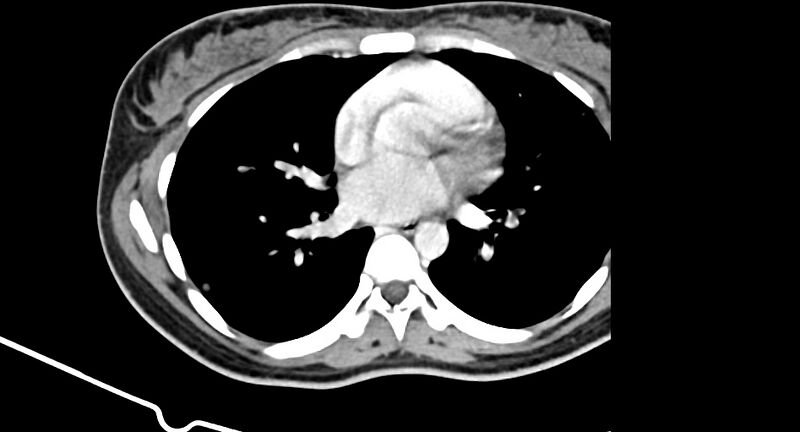 File:Choriocarcinoma liver metastases (Radiopaedia 74768-85766 A 1).jpg