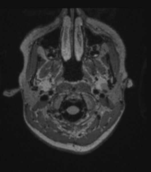 File:Choroid plexus carcinoma (Radiopaedia 91013-108553 Axial FLAIR C+ 68).jpg