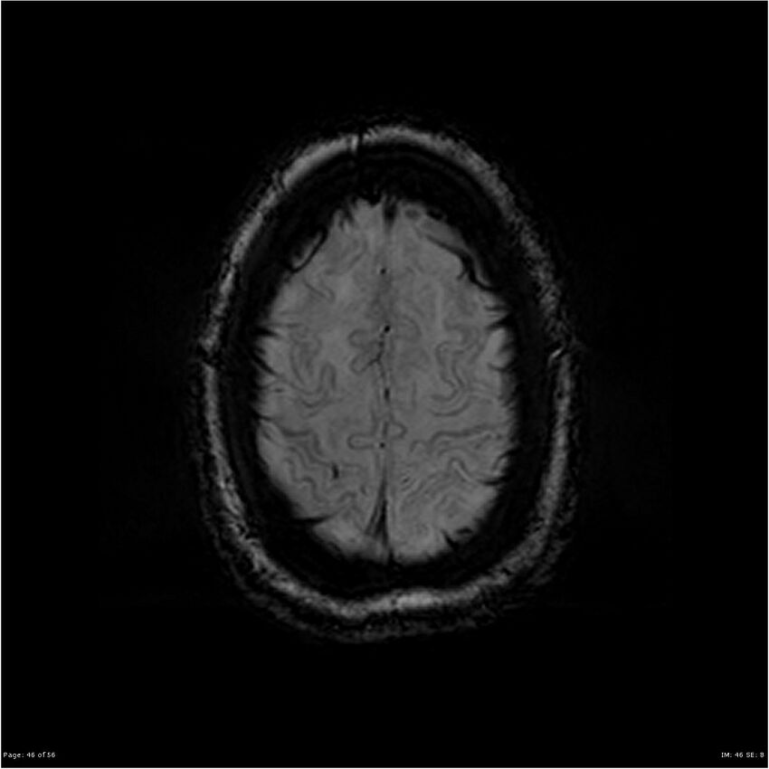 Chronic hypertensive encephalopathy (Radiopaedia 25764-25918 Axial SWI 46).jpg