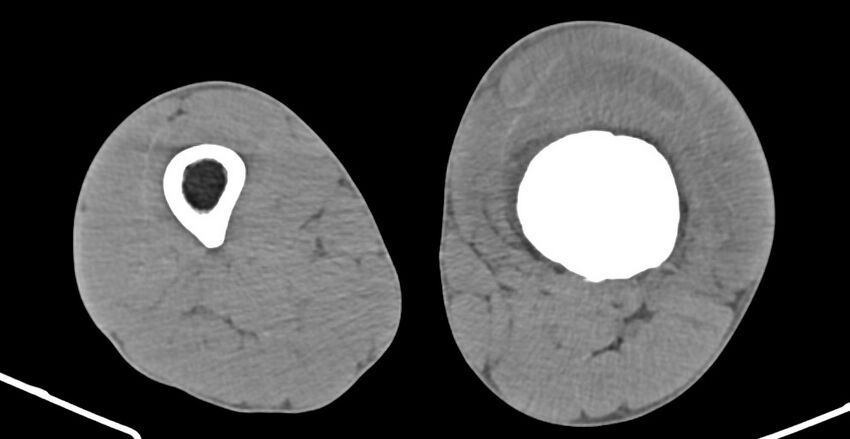 Chronic osteomyelitis (with sequestrum) (Radiopaedia 74813-85822 D 124).jpg