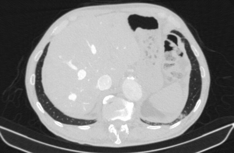 File:Chronic pulmonary embolism (Radiopaedia 91241-108843 Axial lung window 87).jpg