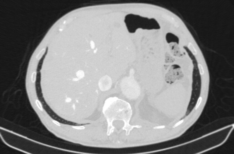 File:Chronic pulmonary embolism (Radiopaedia 91241-108843 Axial lung window 89).jpg