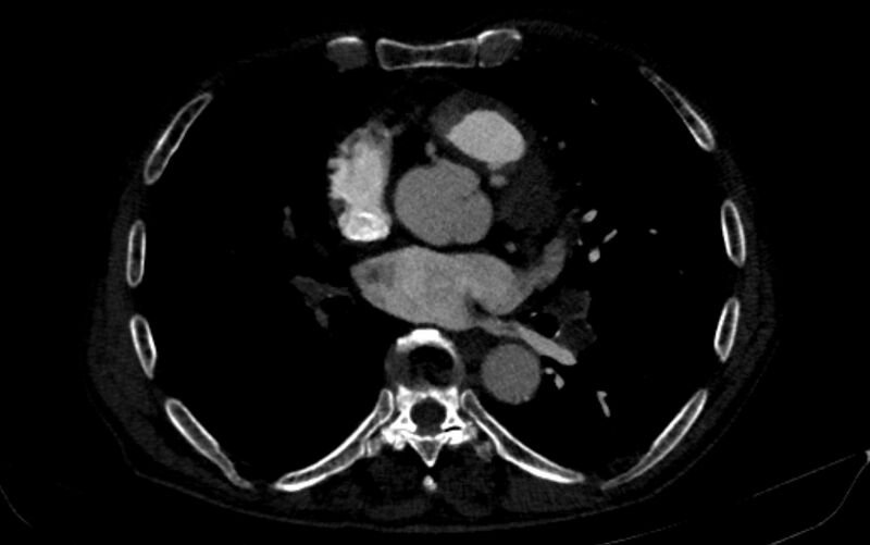 File:Chronic pulmonary embolism (Radiopaedia 91241-108843 B 110).jpg