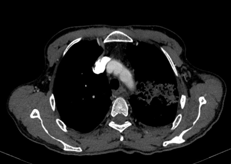 File:Chronic pulmonary embolism with bubbly consolidation (Radiopaedia 91248-108850 C+ arterial phase 30).jpg