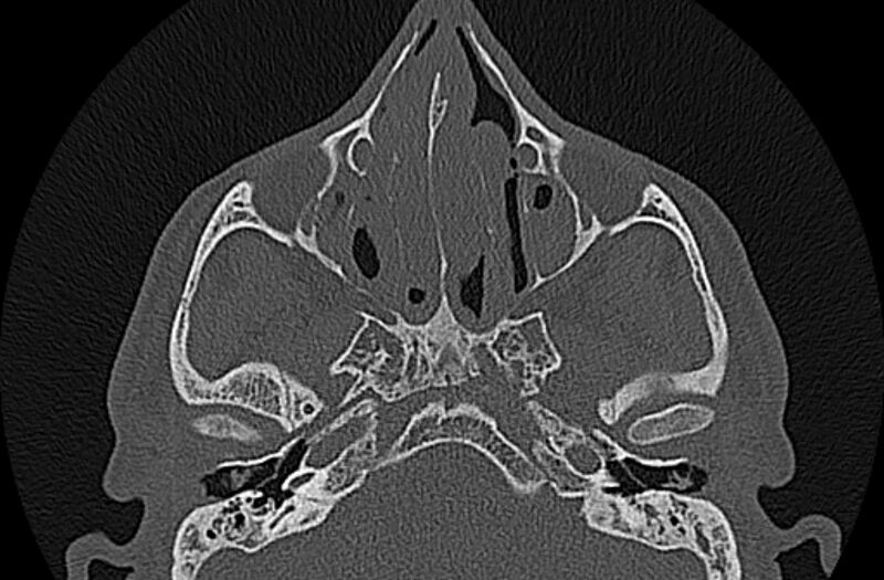 File:Chronic rhinosinusitis (Radiopaedia 65079-74075 Axial bone window 35).jpg