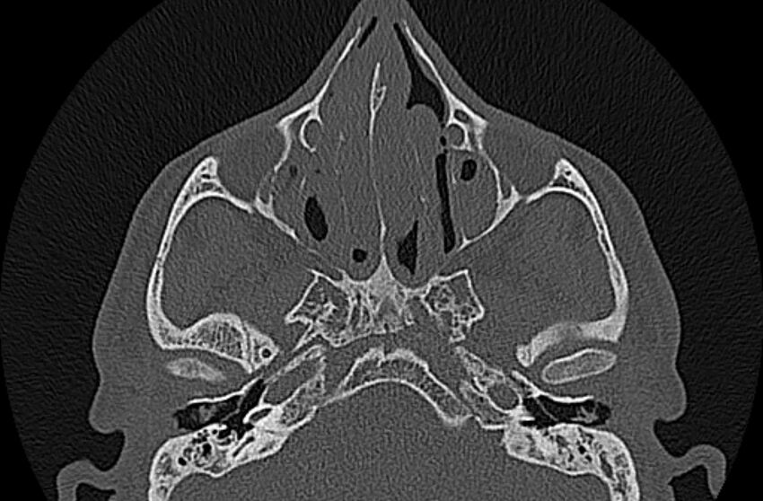 Chronic rhinosinusitis (Radiopaedia 65079-74075 Axial bone window 35).jpg