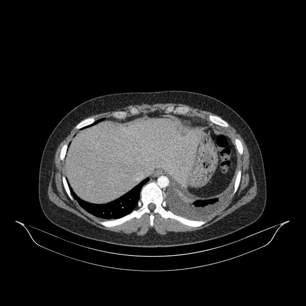 File:Chronic thromboembolic pulmonary hypertension (CTEPH) (Radiopaedia 74597-85532 Axial C+ CTPA 30).jpg